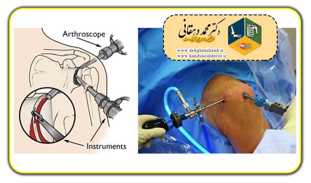 جراحی آرتروسکوپی شانه